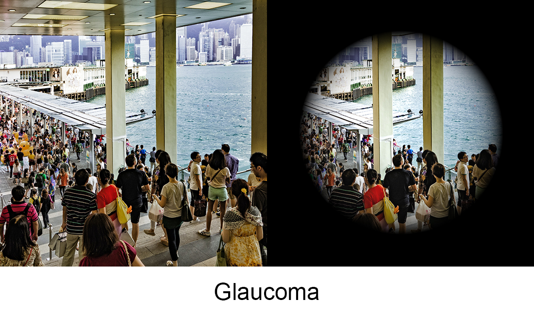 Glaucoma_bv