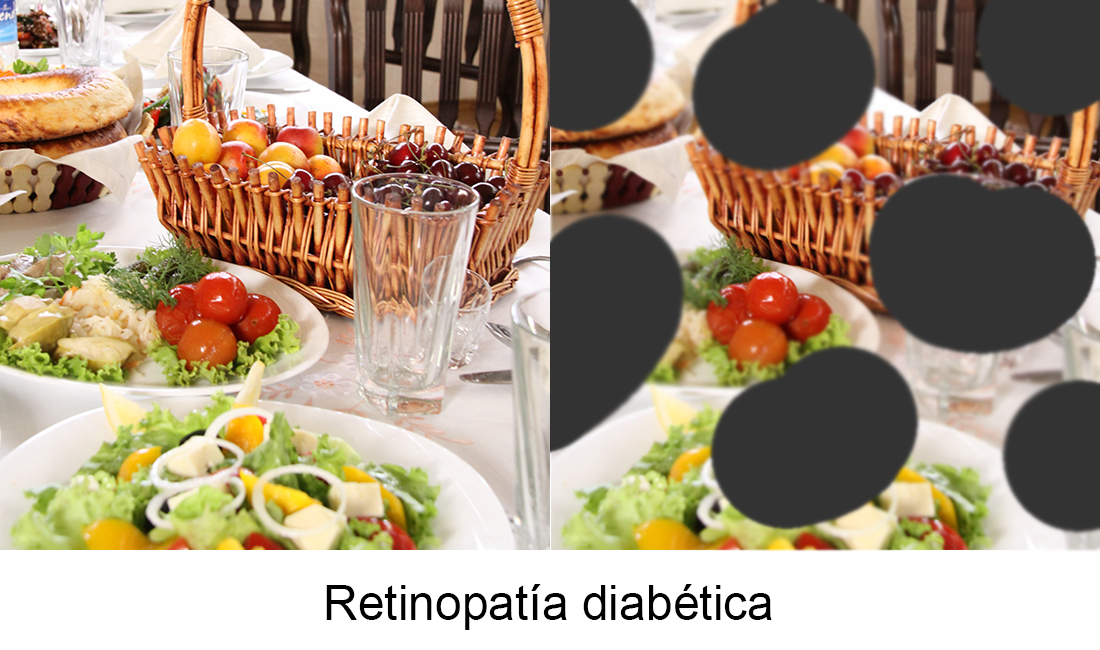 Retinopatia-diabetica_bv